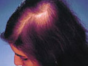 Caduta capelli femminile
